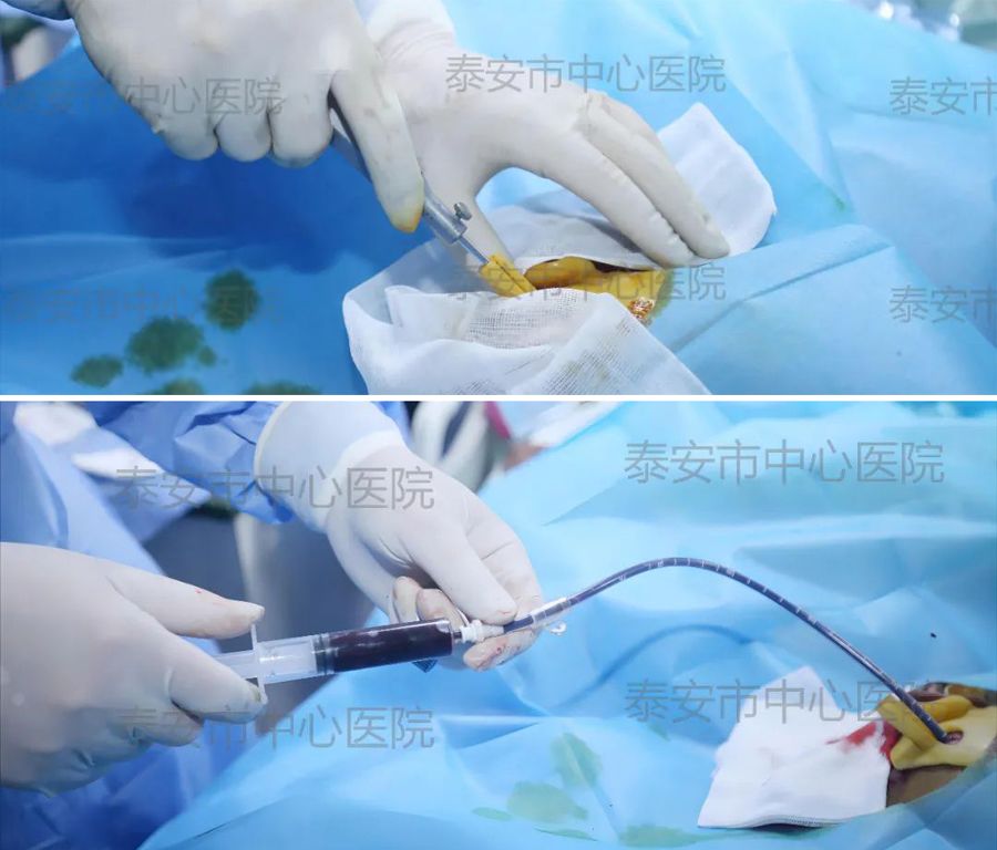 山東泰安3D打印技術為穿刺治療腦干出血患者再添新手段